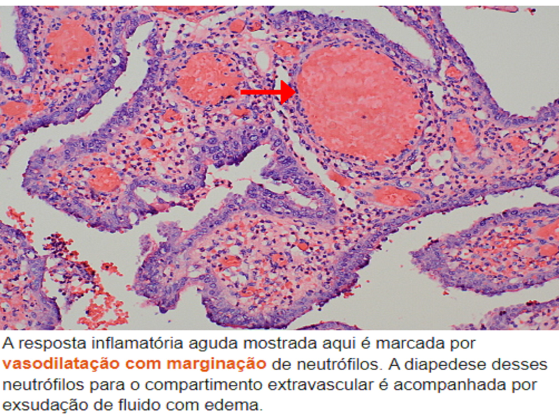 Inflamação puzzle