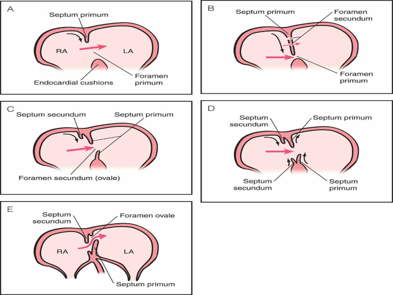 Foramen ovale puzzle